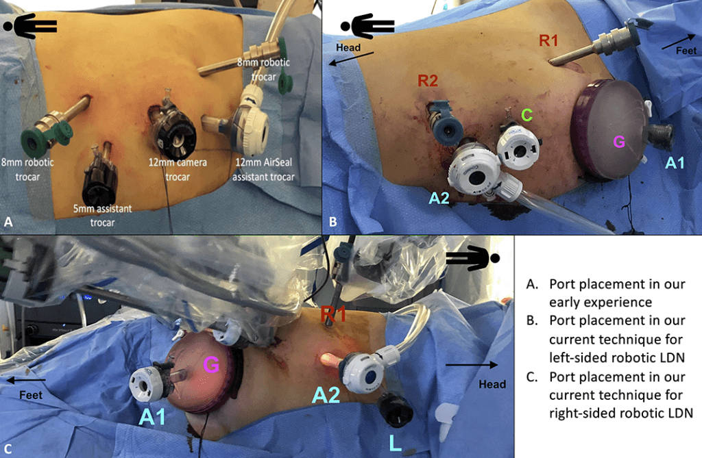 Revolutionizing Kidney Transplantation: A Robotic Approach 1 image 2